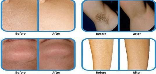 1200W RF E-light IPL Hair Removal Machines Intense Pulsed Light