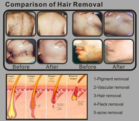 1200W RF E-light IPL Hair Removal Machines Intense Pulsed Light